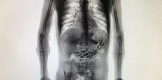 imagem de um scanner corporal mostrando o homem em pé com linhas dos aparelhos dentro do estômago