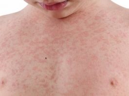 casos sarampo em florianopolis