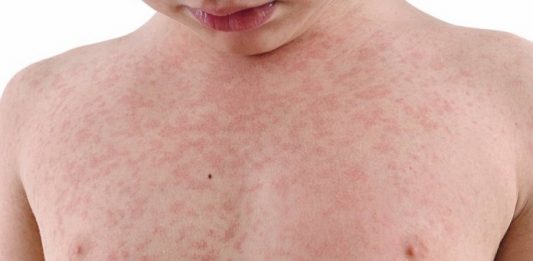 casos sarampo em florianopolis