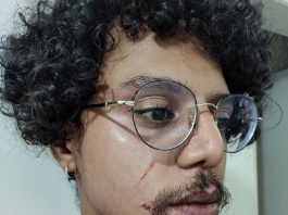 Segurança agride cliente negro: close em renan com pequeno machucado com sangue na bochecha esquerda; ele usa óculos e está com a camisa aberta