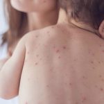 criança com manchas vermelhas nas costas no colo da mãe