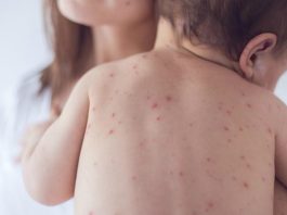Aumentam os casos suspeitos de sarampo em Florianópolis criança com manchas vermelhas nas costas no colo da mãe