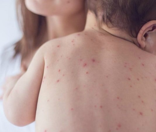 criança com manchas vermelhas nas costas no colo da mãe