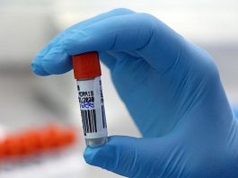 casos suspeitos de reinfecção de coronavírus em sc - close em mão com luva segurando ampola de amostra de sangue