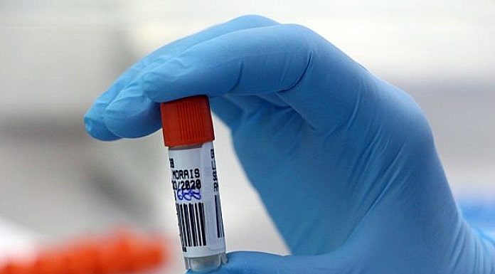 casos suspeitos de reinfecção de coronavírus em sc - close em mão com luva segurando ampola de amostra de sangue