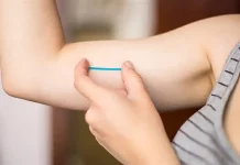 Florianópolis inicia a oferta de Implanon de forma gratuita na rede municipal de saúde Implante contraceptivo Implanon aplicado sob a pele do braço para prevenção da gravidez.