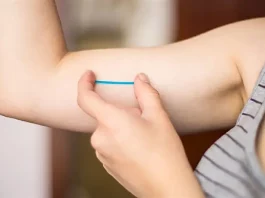 Implante contraceptivo Implanon aplicado sob a pele do braço para prevenção da gravidez.