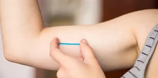 Implante contraceptivo Implanon aplicado sob a pele do braço para prevenção da gravidez.