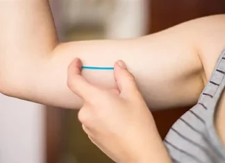 Implante contraceptivo Implanon aplicado sob a pele do braço para prevenção da gravidez.