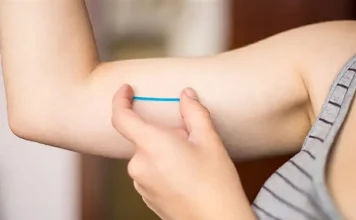 Implante contraceptivo Implanon aplicado sob a pele do braço para prevenção da gravidez.