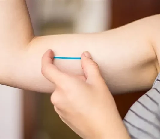 Implante contraceptivo Implanon aplicado sob a pele do braço para prevenção da gravidez.