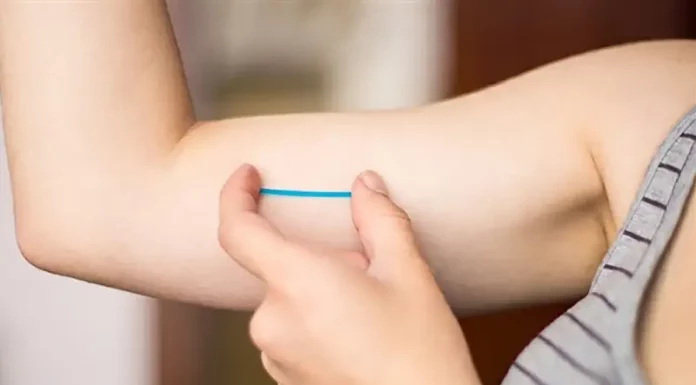 Implante contraceptivo Implanon aplicado sob a pele do braço para prevenção da gravidez.