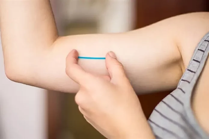 Implante contraceptivo Implanon aplicado sob a pele do braço para prevenção da gravidez.